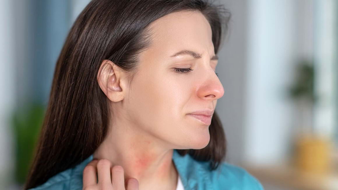 Urticaria la frig - de ce apare și cum se tratează?